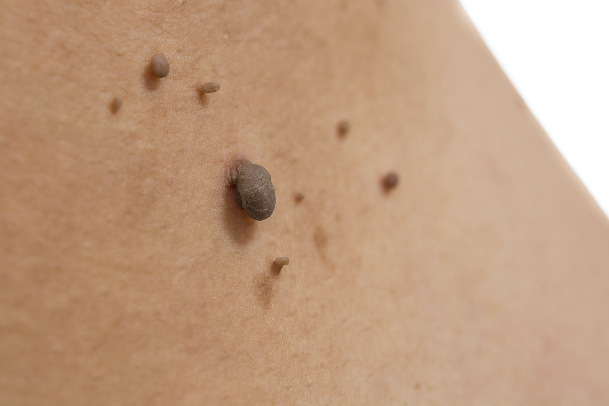 Skin Tag & Mole Removal in Burlington Dermetics
